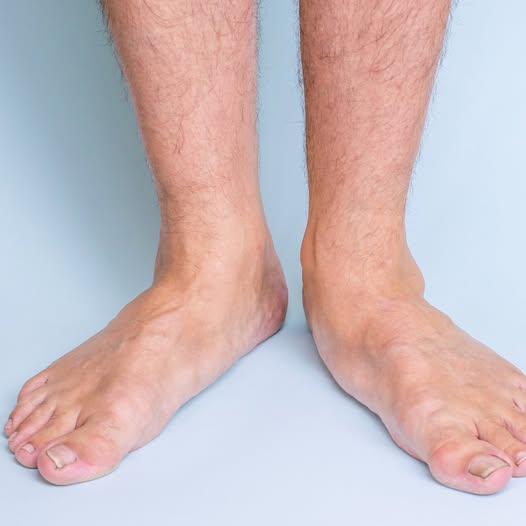 AnneBury0317's tweet photo. Flat feet can cause leg fatigue and pain over time. Supportive footwear and orthotics can make a big difference in your comfort
#FlatFeet #FootSupport #Orthotics #PodiatryTips https://t.co/RSIe3hlaxs
