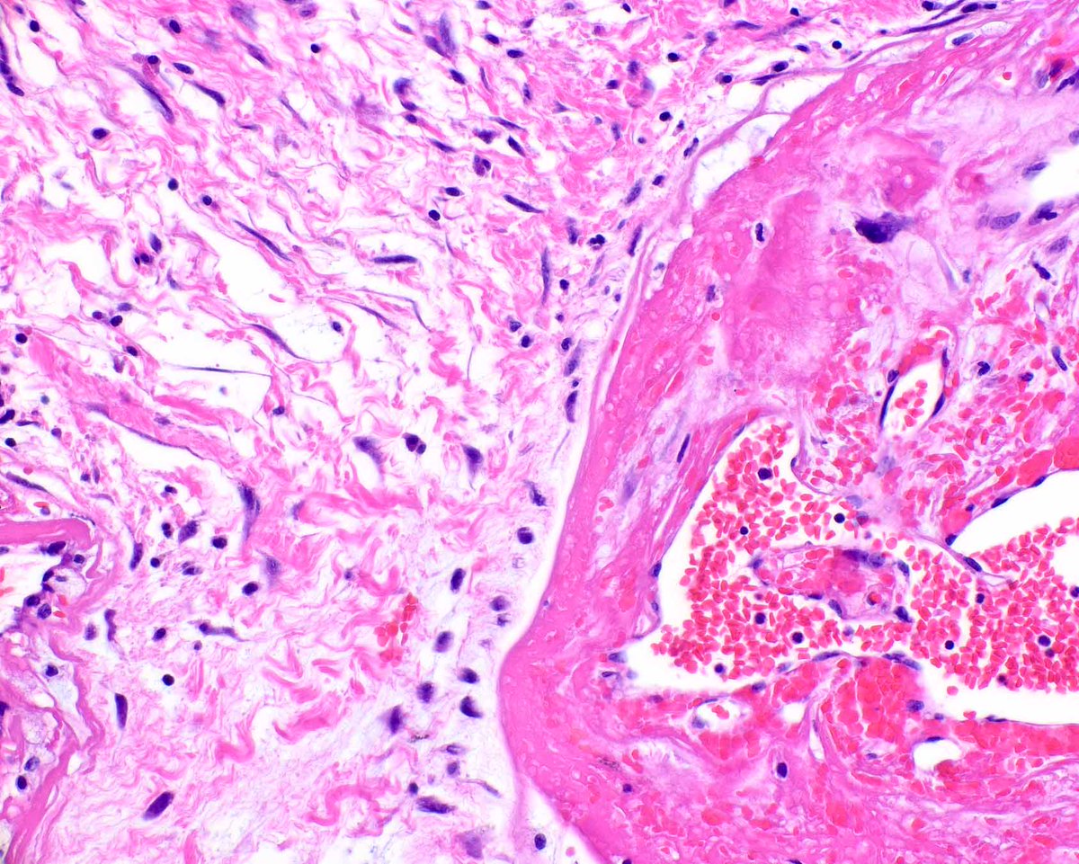 LizMontgomeryMD's tweet photo. Pleomorphic hyalinizing angiectatic tumor, described years ago, is usually indolent; rare progression to high grade sarcoma is known.
Smith ME, Fisher C, Weiss SW. Pleomorphic hyalinizing angiectatic tumor of soft parts. A low-grade neoplasm resembling neurilemoma. MID: 8540605 https://t.co/XAlkMg1Xna