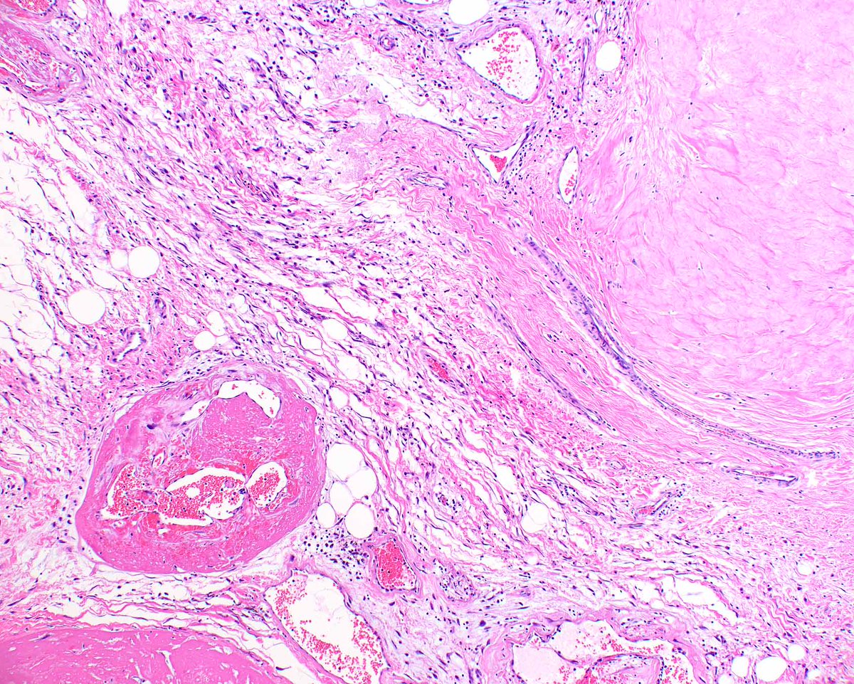 LizMontgomeryMD's tweet photo. Pleomorphic hyalinizing angiectatic tumor, described years ago, is usually indolent; rare progression to high grade sarcoma is known.
Smith ME, Fisher C, Weiss SW. Pleomorphic hyalinizing angiectatic tumor of soft parts. A low-grade neoplasm resembling neurilemoma. MID: 8540605 https://t.co/XAlkMg1Xna