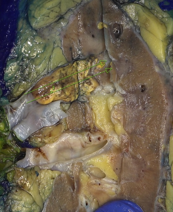 slusagar's tweet image. #grosspath addition 🔪shows some adjacent smaller nodules outpouchings from tumor in renal vein

Dx: pT3a clear cell RCC (with "retrograde" venous invasion)