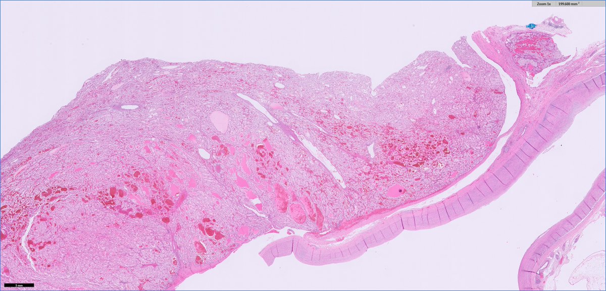 slusagar's tweet image. #grosspath addition 🔪shows some adjacent smaller nodules outpouchings from tumor in renal vein

Dx: pT3a clear cell RCC (with "retrograde" venous invasion)
