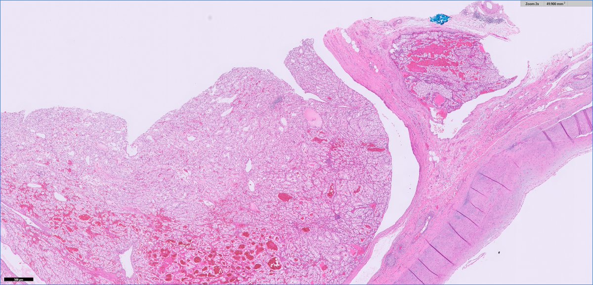 slusagar's tweet image. #grosspath addition 🔪shows some adjacent smaller nodules outpouchings from tumor in renal vein

Dx: pT3a clear cell RCC (with "retrograde" venous invasion)