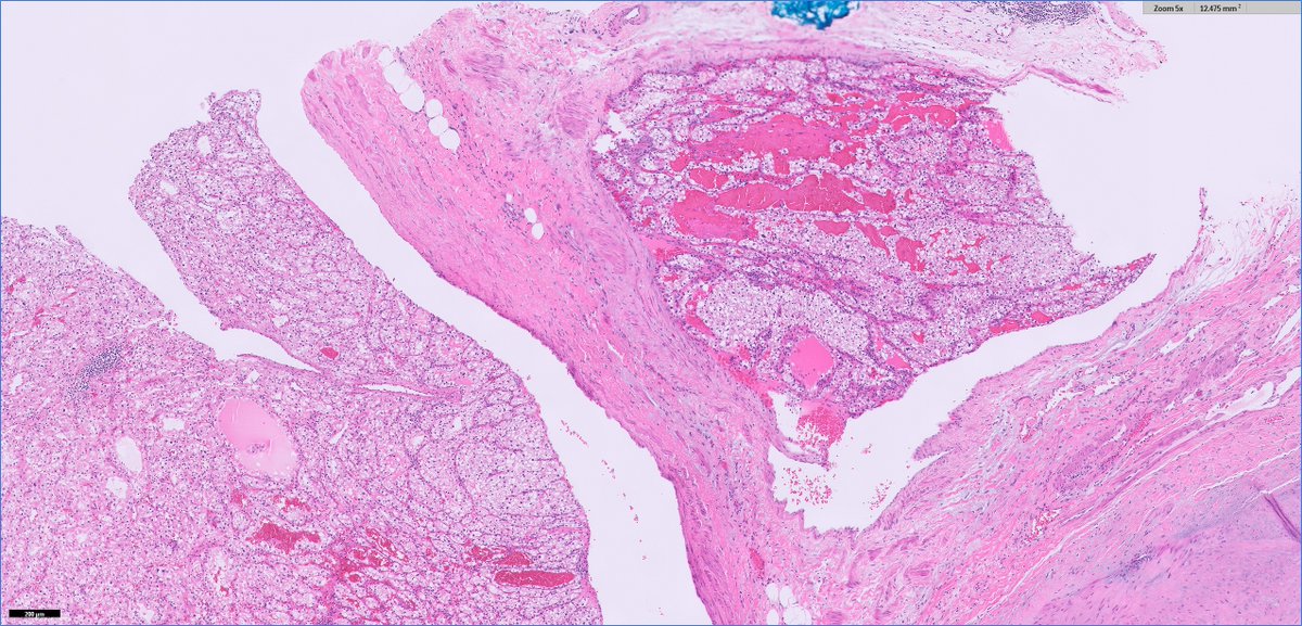 slusagar's tweet image. #grosspath addition 🔪shows some adjacent smaller nodules outpouchings from tumor in renal vein

Dx: pT3a clear cell RCC (with "retrograde" venous invasion)