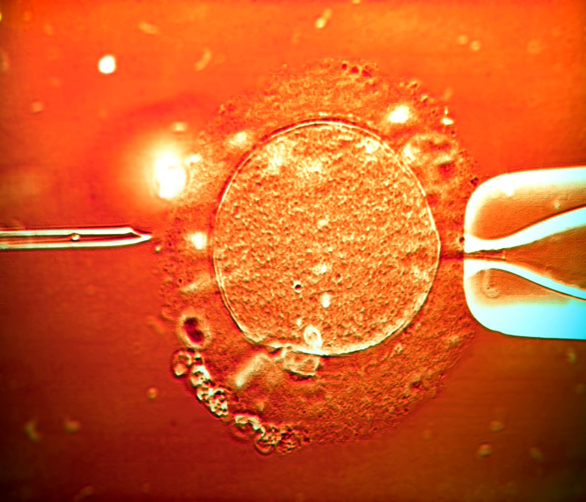 EL ESPERMA DE UN DONANTE CON UN GEN QUE AUMENTA EL RIESGO DE CÁNCER FUE USADO PARA CONCEBIR CASI 200 NIÑOS EN EUROPA

Lectura rápida
Un donante europeo de esperma transmitió una mutación del gen TP53 —asociada al síndrome de Li-Fraumeni y con hasta 90% de riesgo de cáncer— a un