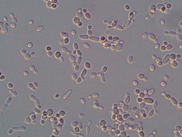 IFM_BioResource's tweet photo. doi: 10.1186/s43162-022-00120-0
発酵食品でおなじみの S. cerevisiae による肺感染症報告。
高齢でCOPD＋GERD＋Zenker憩室を背景に肺実質まで進行。カテーテルなし。AMPBでも改善せず...と。
本菌の場合、誤嚥、食品の腸管由来が疑われるも確証ではない。 https://t.co/ySWs0ityfH