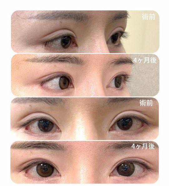 pipia2020's tweet photo. 二重修正専門のホスンホ美容外科で、二重修正（ハム目修正）をしてから、4ヶ月が経過しました✨
@huhpsjp https://t.co/4R4LhOTC3m