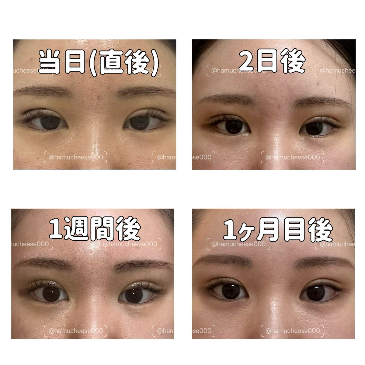 hamucheese000's tweet photo. 【腫れの変化】
☑️目尻に向かって幅が広くなるのが好みだと伝えた
☑️1週間目からは目の周りに少し緑〜黄色っぽいあざと浮腫が出てきた
☑️2週間目くらいで腫れや色素が落ち着いた
☑️目を瞑ったときの食い込みはまだある

⚠️全て目元メイク無し／iPhoneでの自撮り／肌管理後で肌が汚いので閲覧注意 https://t.co/utoq2KSAnr