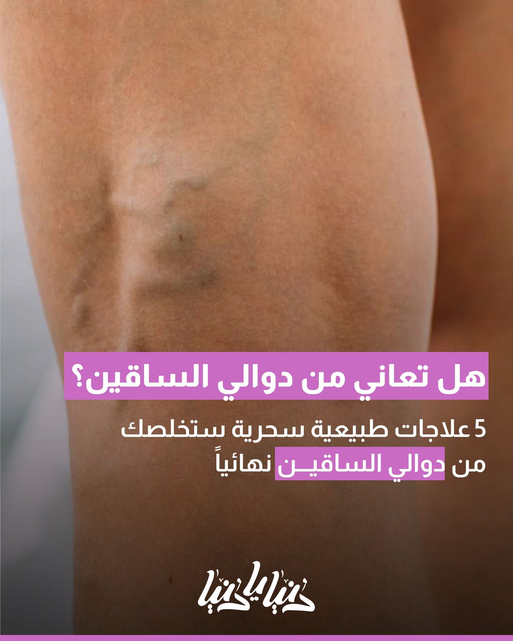 5 علاجات طبيعية سحرية ستخلصك من دوالي الساقين نهائياً 
