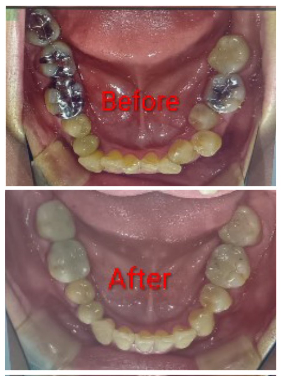 2年半に及ぶ歯の矯正治療が終わりました！

元に戻るのを防ぐためにマウスピースの装着はこれからも続くけれど、治療が一段落してホッとしています♪

骨格が変わって、みんなに小顔になったって言われるのも嬉しい笑

自分の記念にビフォーアフターの写真を載せておきます😆