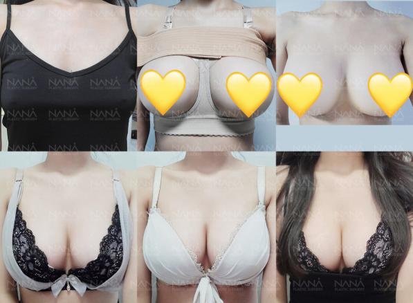 韓国豊胸No.1🥇NANA美容外科 【シリコンバッグ豊胸】ダウンタイム経過