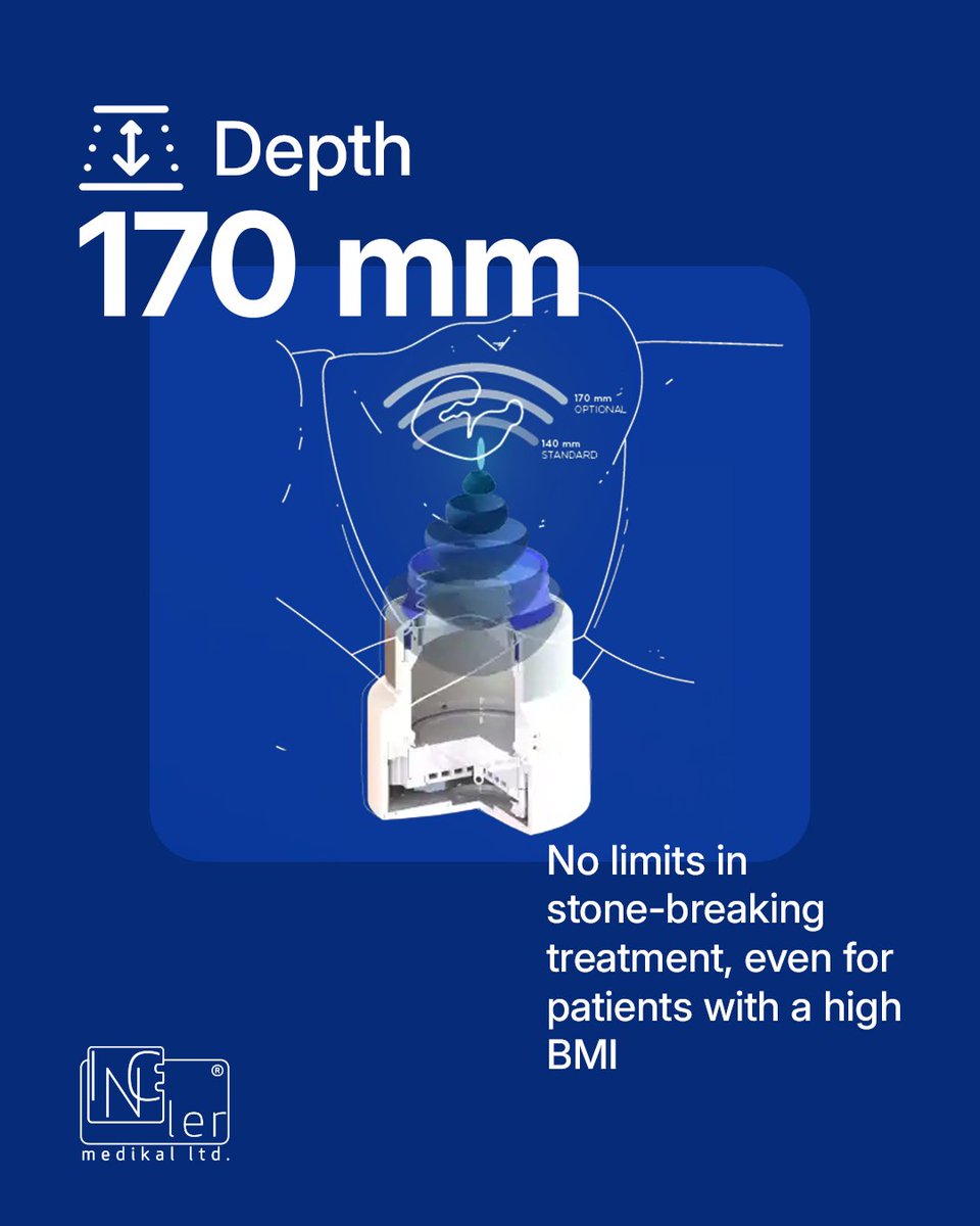 incelermedikal's tweet image. Success in lithotripsy begins with your ability to reach critical points. Spark EM ESWL combines motorised precision and competitive penetration depth to deliver definitive results even in challenging cases.

#SparkEMESWL #Urology #StoneCrushing #Lithotripsy #MedicalTechnology