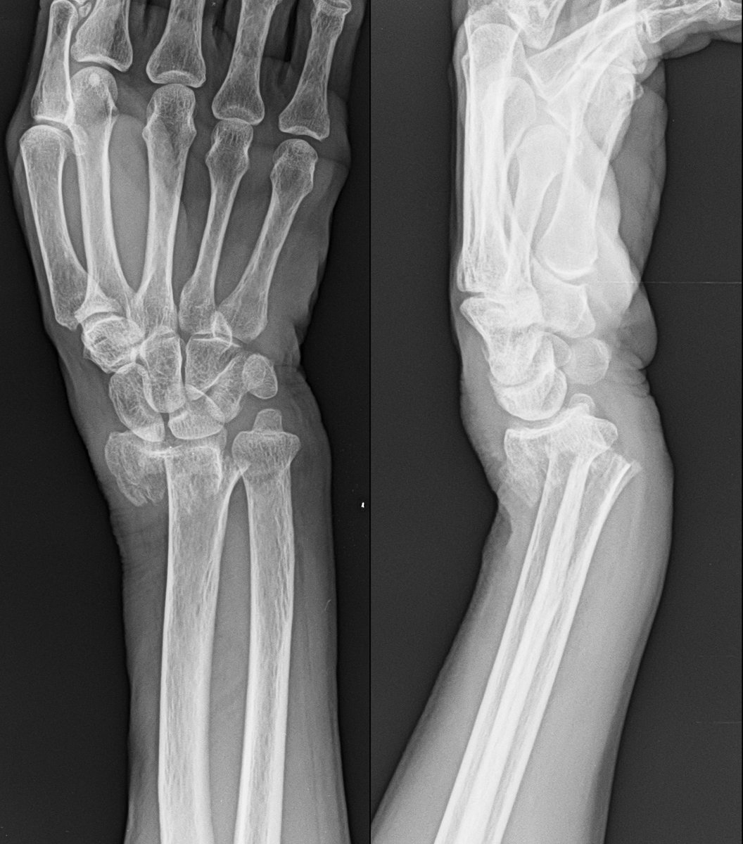 pratikorho's tweet image. Distal radius displaced Comminuted fracture in 62 yr old woman in non dominant hand!

Close reduction and k wiring with plaster !

#medtwitter #orthotwitter #orthox #medx
