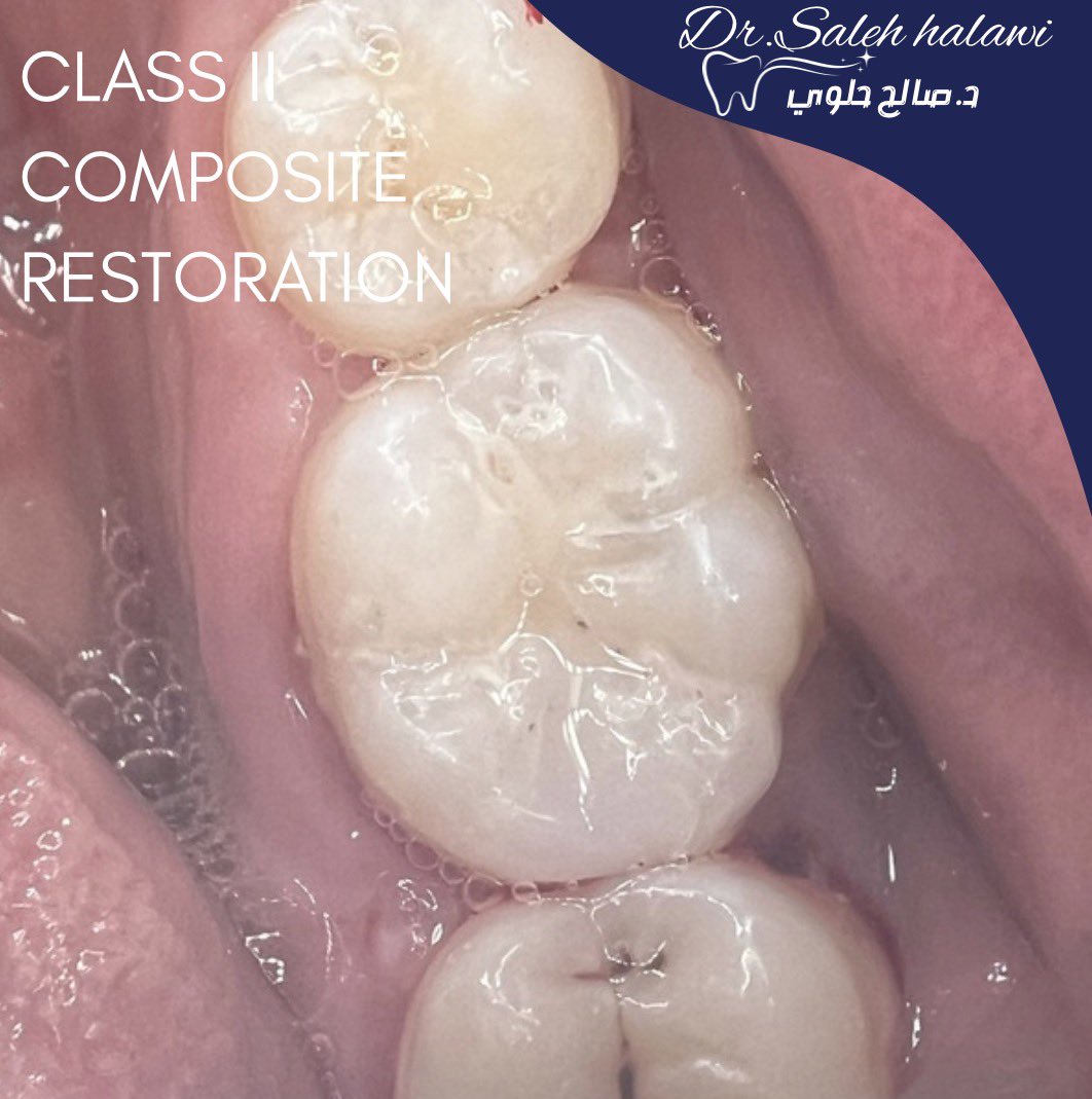 Fisrt class II composite restoration under+ fissure sealant under rubber dam isolation 🙌🏻