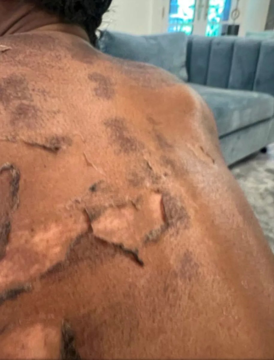 TheRhoaTalk's tweet image. Shamea sues doctor over chemical peel gone wrong. #RHOA

Source: usmagazine.com/celebrity-news…