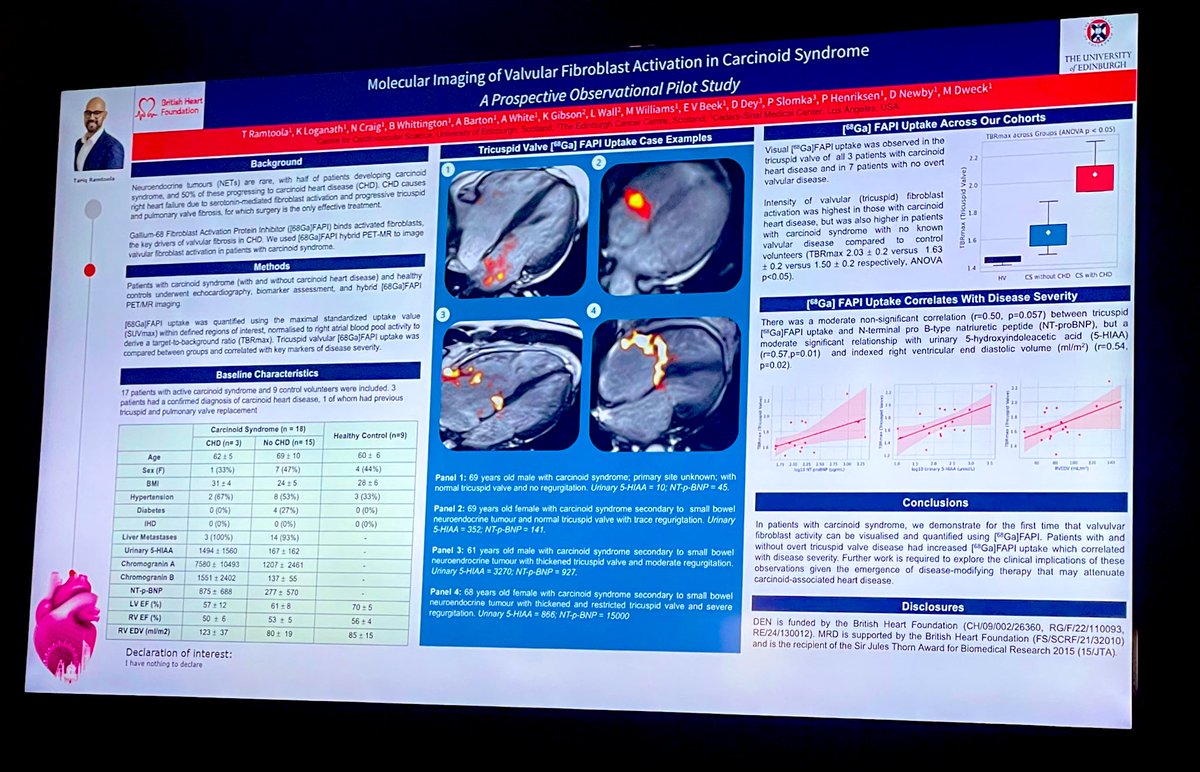 AnnaKateBarton's tweet photo. Is there anything that FAPI PET can’t do ✨ ☢️ 🩻

Fibroblast activation detected by 68Ga FAPI PET/MR is implicated in tricuspid valve disease in carcinoid syndrome

Nice data from @EdinburghUni @KrithikaLogana2 @TariqRamtoola 👏🏼 @EdRadiopharmacy @EdinUniImaging https://t.co/QaCy5JdnE9