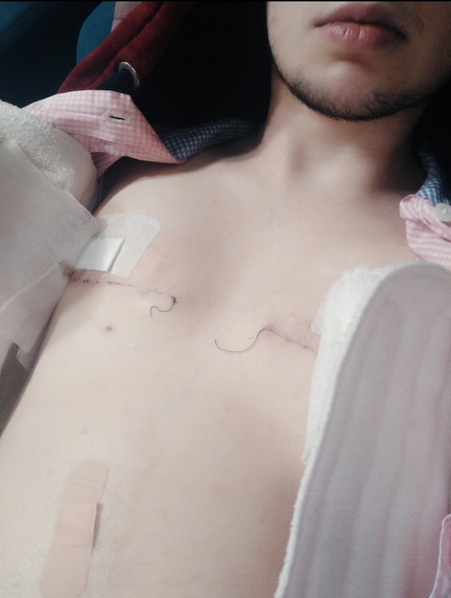 maxdym's tweet photo. Got that top surgery finally! 💪💪💪

Tw bit of stiches visable not fully healed 
Bit of blood visable on bandage (very lil not that noticeble tho) https://t.co/Lsf7svttqu