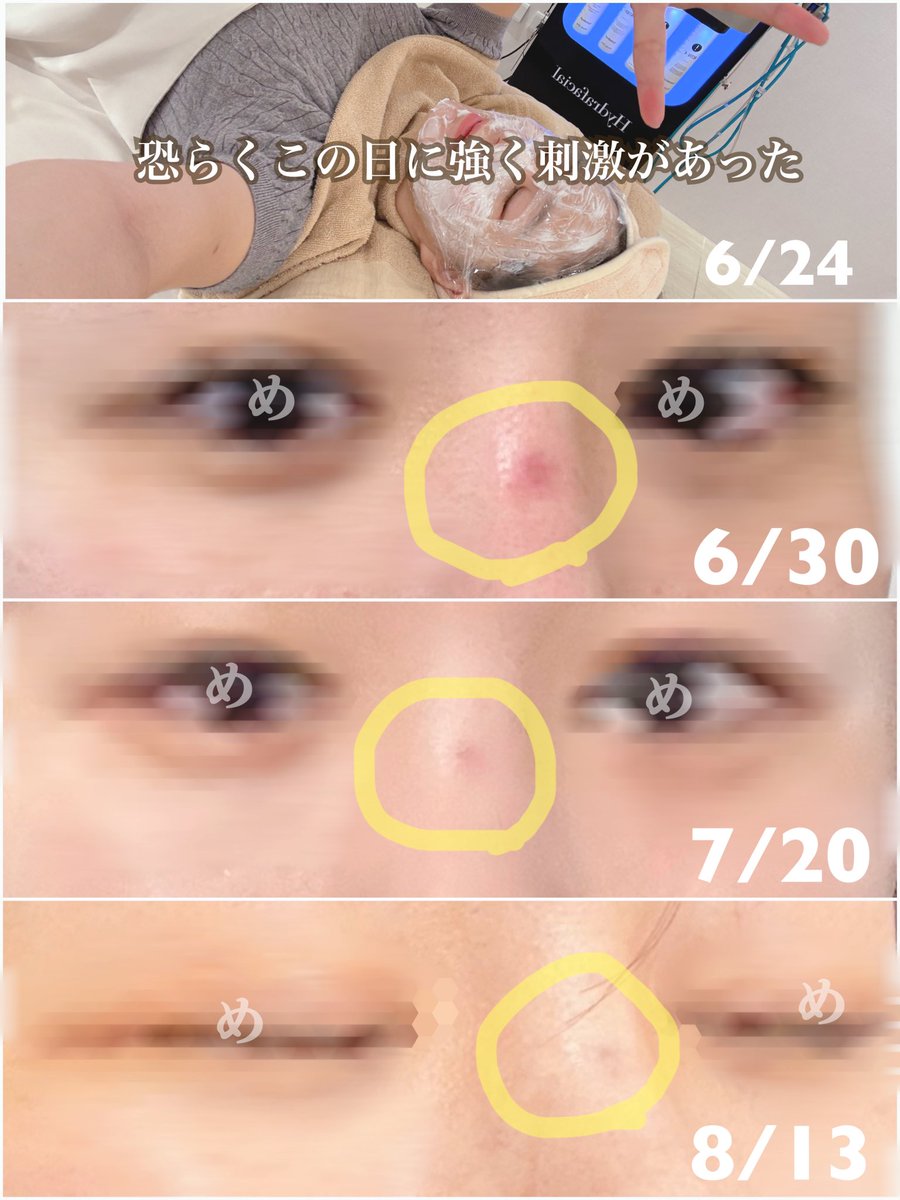 seikei_30's tweet image. ⚠️鼻整形した方は肌管理も鼻筋は当てないよう注意徹底してもらった方がいい⚠️
ニキビ？と気長に見てたんだけど、どうやら違う。炎症でほぼ確と思う。

シートに記載はしてたものの、施術者に口頭でも言うべきだった😔こんな些細なことで炎症するのはアホらしいからぜひ反面教師に