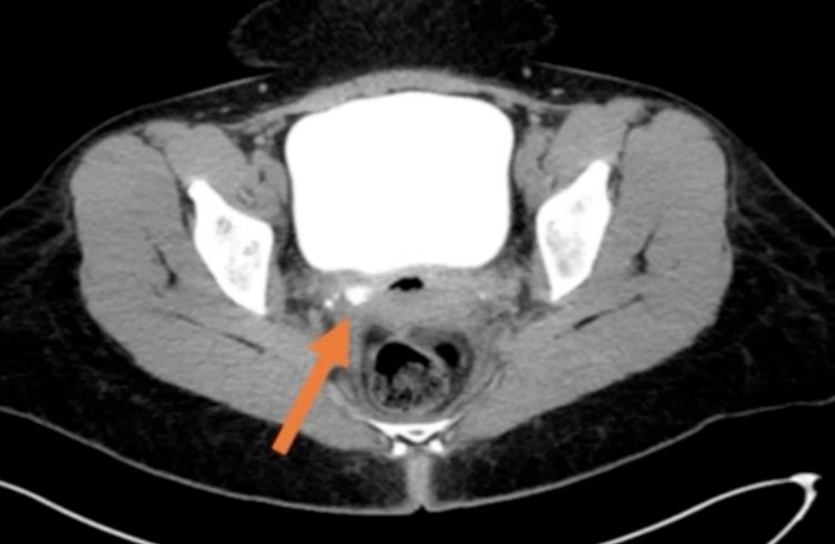 IFRUEUrol's tweet photo. 📚Proud to feature our latest case series in @urovidjournal
🤖Robotic UV Fistula🥤repair continues to evolve, with excellent outcomes, low blood loss, and quick recovery🏃
#UroTwitter #UroSoMe #IFRUE https://t.co/mrcNHIVa9D