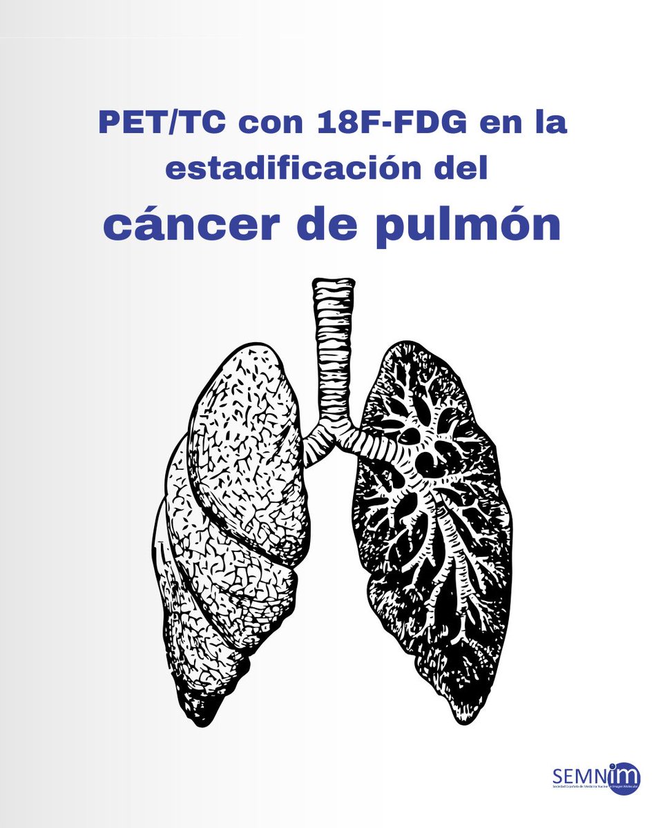 SEMNIMoficial's tweet photo. El PET/TC con 18F-FDG es hoy una herramienta clave en el diagnóstico y estadificación del #cáncerdepulmón 🫁⚛️.

Permite detectar lesiones metabólicamente activas no visibles en Rx o TAC convencional.

#PETTC #18FFDG #MedicinaNuclear #ImagenMolecular #Oncología #CáncerDePulmón https://t.co/RmXJX71ykv
