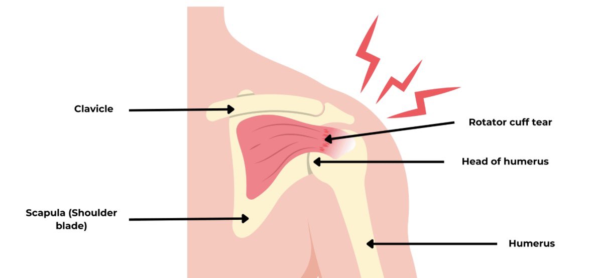 GiftinW's tweet photo. The one common beginner’s gym injury that I see again and again is the Rotator cuff injury (commonly reported as shoulder pain while pushing and external rotation)

Cause:
- Lack of warm-up
- No progression
- Ego lifting
- Bad form

Encountered 7 in a month. https://t.co/iGZpD425Gj