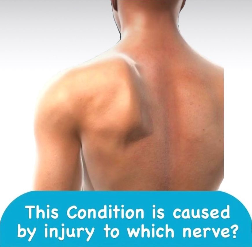 👨🏻‍⚕️ تنتج هذه الحالة عن إصابة في أي عصب❓🤔