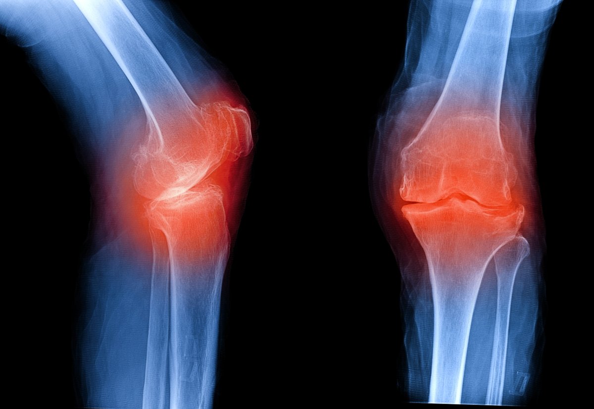 eMPR's tweet image. A once-weekly triple hormone receptor agonist has promising results in treating obesity/overweight and knee ostheoarthritis. empr.com/news/triumph-4…