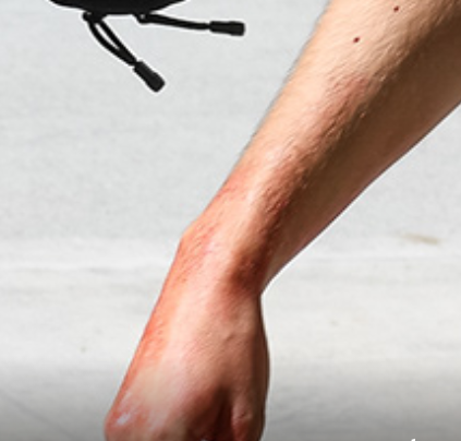 What is is this discoloration on Charlie Kirk's hand and arm as he is being carried away?  My first instinct was the obvious--blood.  But his other arm is full of liquid blood and this one looks entirely different.  

Any guesses?  For reference, this is his right hand.