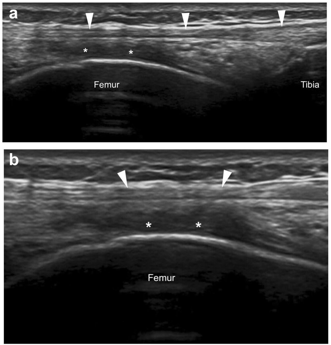 MedEd_Cases's tweet photo. Iliotibial (IT) band syndrome is an overuse injury in which the IT band becomes irritated as it rubs over the lateral femoral condyle, causing sharp or burning pain on the outside of the knee. Diagnosis is clinical, based on lateral knee pain worsened by running or descending stairs, along with tenderness over the IT band and sometimes positive Ober or Noble tests. Treatment focuses on activity modification, stretching the IT band and hip abductors, strengthening the gluteal muscles, and using ice or NSAIDs, with gradual return to activity once symptoms improve.

Read: https://t.co/DJj8MhOPDw

#SportsMedicine #Orthopedics #PhysicalTherapy #AthleticTraining #Rehab #InjuryPrevention #Physio #SportsInjury #SportsRehab #PhysioTherapy #Meded #ATC #FOAMed