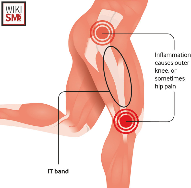 MedEd_Cases's tweet photo. Iliotibial (IT) band syndrome is an overuse injury in which the IT band becomes irritated as it rubs over the lateral femoral condyle, causing sharp or burning pain on the outside of the knee. Diagnosis is clinical, based on lateral knee pain worsened by running or descending stairs, along with tenderness over the IT band and sometimes positive Ober or Noble tests. Treatment focuses on activity modification, stretching the IT band and hip abductors, strengthening the gluteal muscles, and using ice or NSAIDs, with gradual return to activity once symptoms improve.

Read: https://t.co/DJj8MhOPDw

#SportsMedicine #Orthopedics #PhysicalTherapy #AthleticTraining #Rehab #InjuryPrevention #Physio #SportsInjury #SportsRehab #PhysioTherapy #Meded #ATC #FOAMed