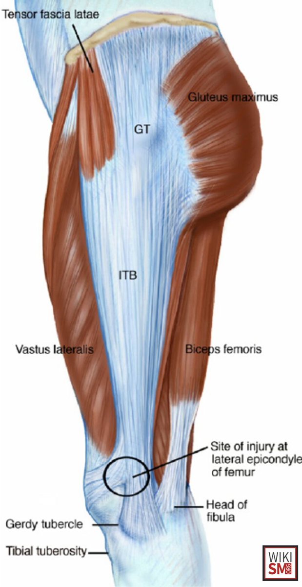 MedEd_Cases's tweet photo. Iliotibial (IT) band syndrome is an overuse injury in which the IT band becomes irritated as it rubs over the lateral femoral condyle, causing sharp or burning pain on the outside of the knee. Diagnosis is clinical, based on lateral knee pain worsened by running or descending stairs, along with tenderness over the IT band and sometimes positive Ober or Noble tests. Treatment focuses on activity modification, stretching the IT band and hip abductors, strengthening the gluteal muscles, and using ice or NSAIDs, with gradual return to activity once symptoms improve.

Read: https://t.co/DJj8MhOPDw

#SportsMedicine #Orthopedics #PhysicalTherapy #AthleticTraining #Rehab #InjuryPrevention #Physio #SportsInjury #SportsRehab #PhysioTherapy #Meded #ATC #FOAMed