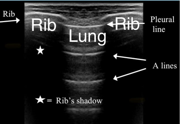DrJesseMorse's tweet photo. The reason why Justin Herbert’s career started when it did is because Tyrod Taylor was receiving an injection, likely either cortisone or a nerve block, along the rib area in the performing party penetrated too far and ended up putting the needle into the lung, causing what we call a pneumothorax.

He needed to be shut down for a month and the rest is history.

This is also why I only perform these under ultrasound and let the patient know not to move because there is very little margin for error. I actually did one of these yesterday.

This is what it looks like on Ultrasound, mind you there is less than 1” of space between the skin, rib and lung (depending on the person). 

I hope we are not seeing a repeat of this situation with TJ Watt.
