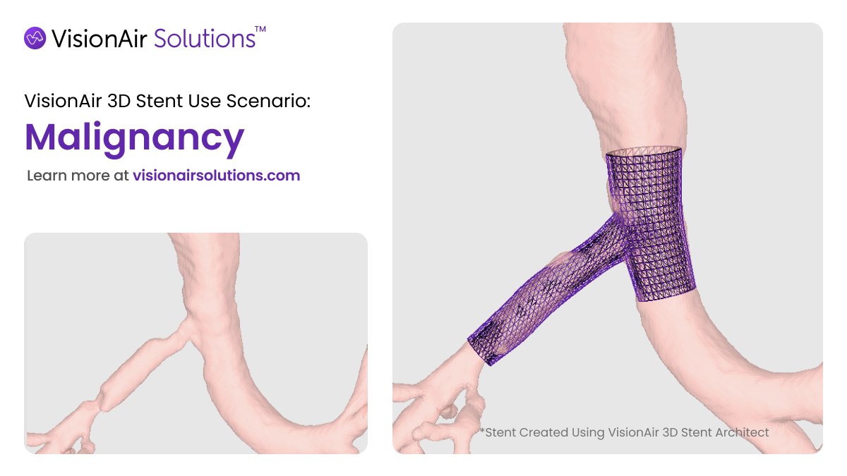 VisionAirStents's tweet photo. #MalignancyMonday

This #MalignancyMonday, we’re focusing on the value of patient-specific 3D stents in airway care. Unlike single-lumen or off-the-shelf Y-stents, 3D stents are customized to fit the patient’s unique airway anatomy, offering a more precise solution.

Whether as an alternative to traditional stents or as a first-line option, 3D stents provide a tailored approach that can improve fit, reduce complications, and potentially enhance patient outcomes.

#Malignancy #3DStent #Custom #AirwayCare #Pulmonology