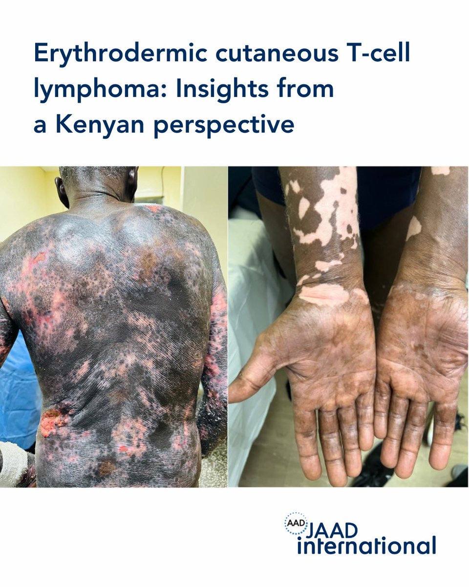 JAAD Journals tweet media