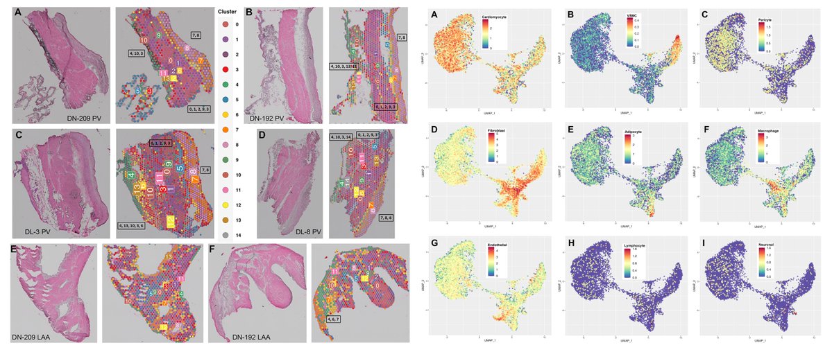 HaoYin20's tweet image. #SpatialTranscriptomics 
Visium @10xGenomics

Human Left Atrial Appendage (n=2 donors) &amp;amp; Pulmonary Vein (n=8 donors)

Spatial location of #AtrialFibrillation risk genes PITX2 SHOX2 HCN4

@CVpathol 2025
sciencedirect.com/science/articl…