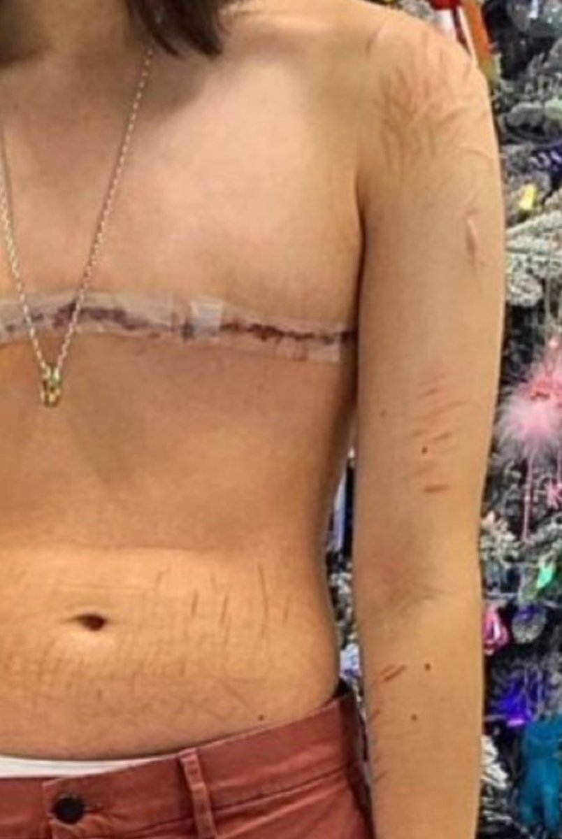 TheHoleTweet's tweet image. Is this what you guys want to see Gavin? 

Look at this girl's arms and stomach, there's cuts all over them. She didn't need a double mastectomy, she needed help. You people are sick. 🤬