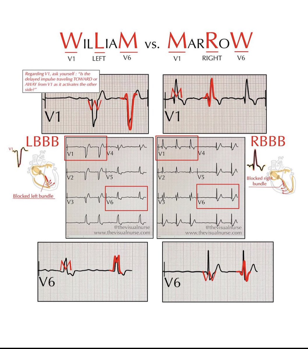 TrackYourHeart's tweet photo. Left bundle branch block Vs Right bundle branch block https://t.co/UthqUiZOBj