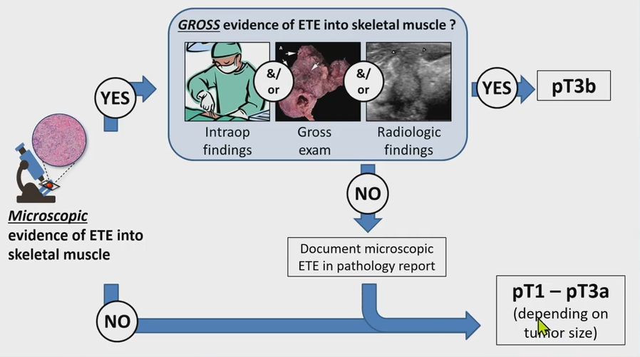 Extrathyroidal Extension

If there are intraoperative findings, gross examination, or radiologic findings supporting ETE into muscle (in addition to microscopic evidence), stage as pT3b.

If only microscopic ETE is present without such supporting evidence, stage as pT1–pT3a based