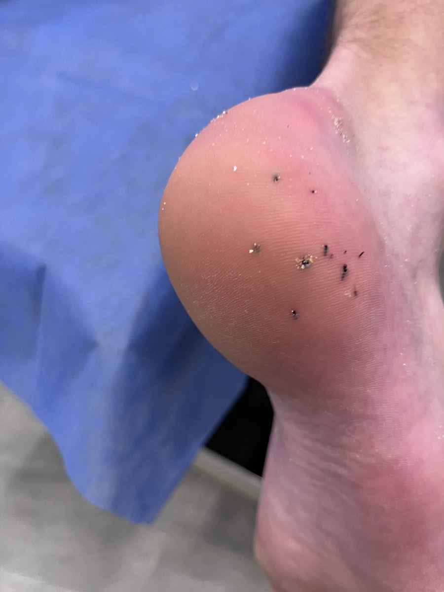 Sea Urchin 1: Quigs 0 

* more like 10-0