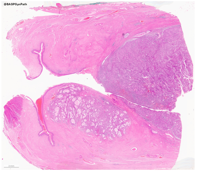 BAGPGynPath's tweet photo. BAGP Case of the Month🔬
Not your usual endocervical adenocarcinoma!

49-year-old woman with a large cervical mass. TAH with BSO and LN dissection performed.
IHC: p16 ‘block positive’

Answers to follow next Friday!

#BAGPCaseoftheMonth #BAGPCotM #GynaePath #GynPath #PathTwitter #PathQuiz