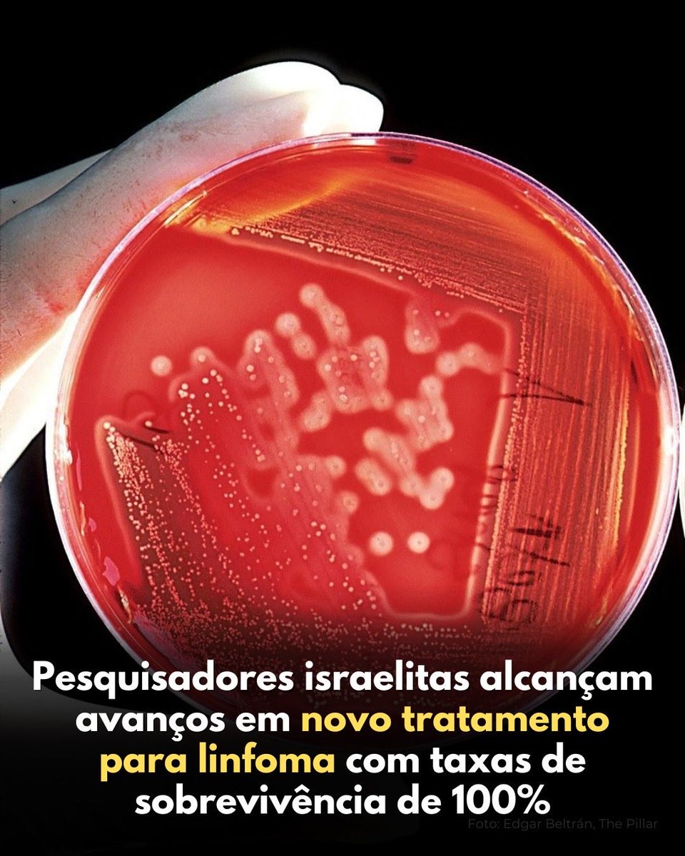 Um tratamento inovador para o linfoma desenvolvido em Israel apresentou taxas de sobrevivência impressionantes de 100%.
O estudo israelita de grande escala foi conduzido em 15 centros médicos do país e examinou uma nova abordagem terapêutica para o linfoma de Hodgkin em estágio
