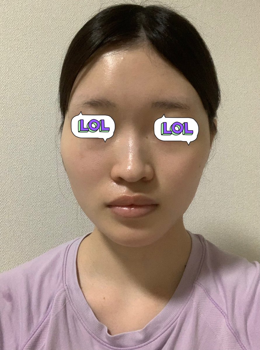 セギムで輪郭3点をして1年経ちました!執刀医はキム院長です👨⚕️
元々頬骨とエラ張りがコンプレックスだったんだけど、輪郭3点をしたことで卵形の女性らしい輪郭に近づいた!
1枚目:整形前(鼻も未整形)
2枚目:輪郭3点術後12ヶ月(鼻は他院で施術済み)
※どちらも無加工 https://t.co/43wLSqLPSU