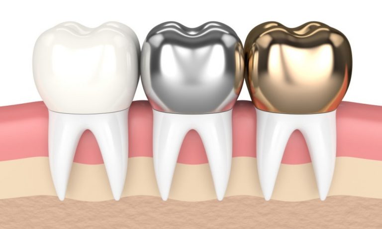 What Materials Are Used in Dental Veneers, Crowns, or Implants?

ow.ly/WOnx50XsTVw
#dentalimplants #dentalcrowns #veneers #smile