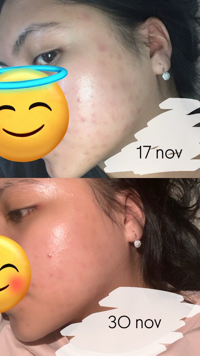 tunacado0o's tweet photo. @tanyarlfes mungkin bisa membantu kak? 
aku lagi rutinin pake serum aboveboard dan moist lrp tonernya aku pake dalba sejauh ini bagus bgt buat mudarin dark spot. pake jelly mask eileen grace jg tiap malam + sheetmask 2-3x seminggu dan selaluuu pake ss, harus telaten biar hasilnya maksimal https://t.co/p2iyX0Xda5