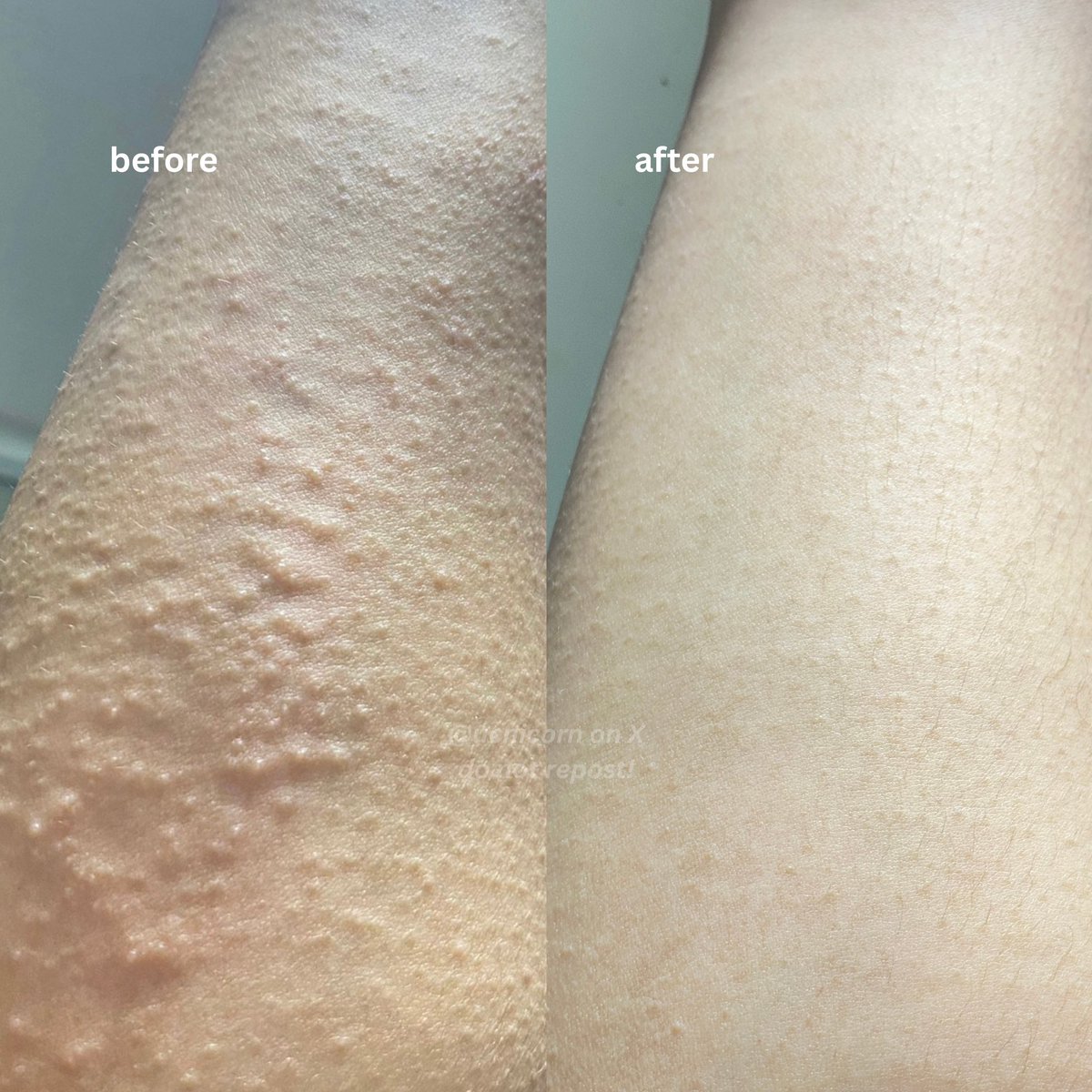 ⚠️ CW TW // kulit iritasi

this soap really calms my irritated skin without drying it out😳✨