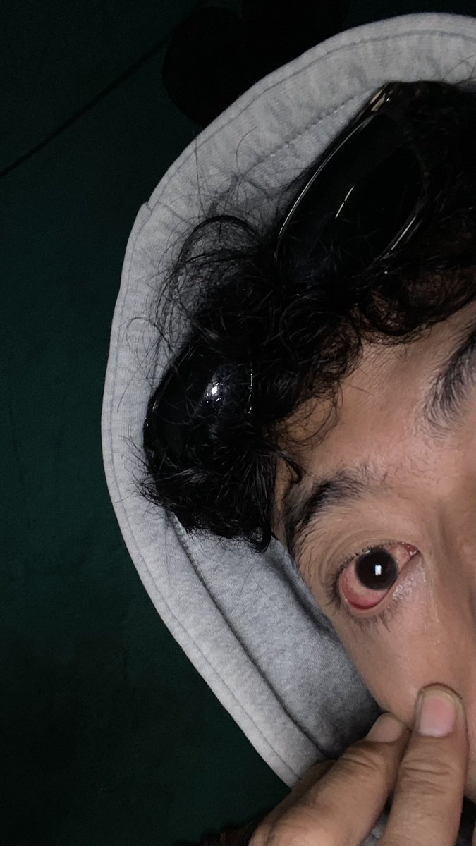 monyet lama bgt ga sembuh sembuh ni mata