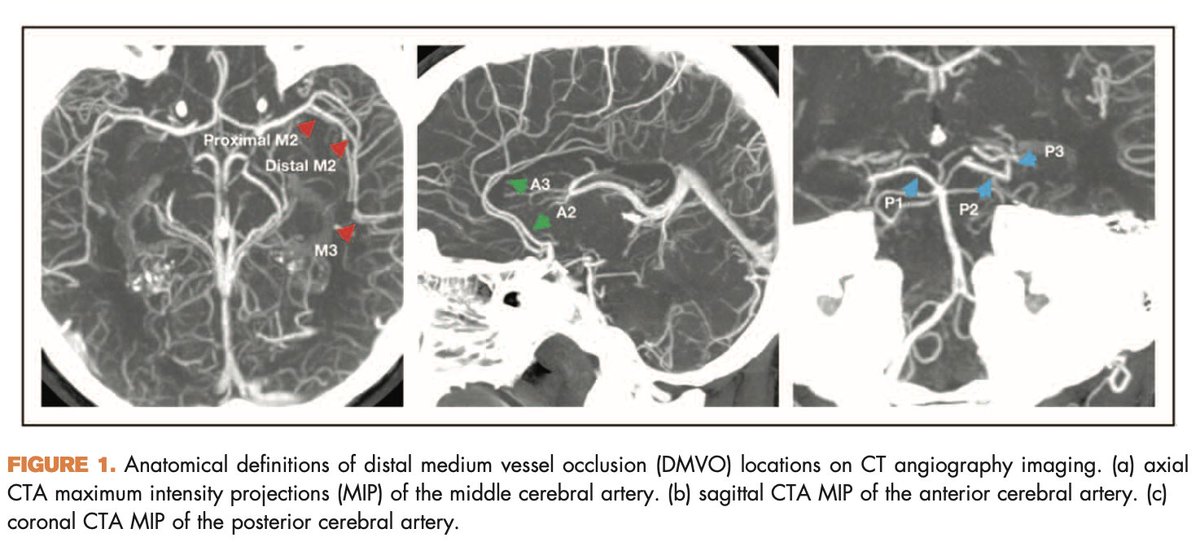 UPensato's tweet photo. What have we learned from 1-st generation #thrombectomy trials in MeVO #stroke? How do they inform clinical practice and 2nd generation trials design? take a look at our latest review @a_ciacciarelli @johanna_ospel @CO_Neurology @HUNIMED @DCNSNeuro  https://t.co/eX15LHsvx5 https://t.co/i20lxh0aku