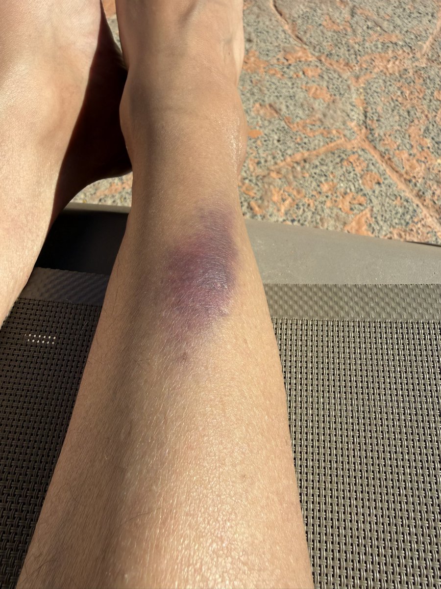 First world problems.

Caused by a pissed up German. Obvs.