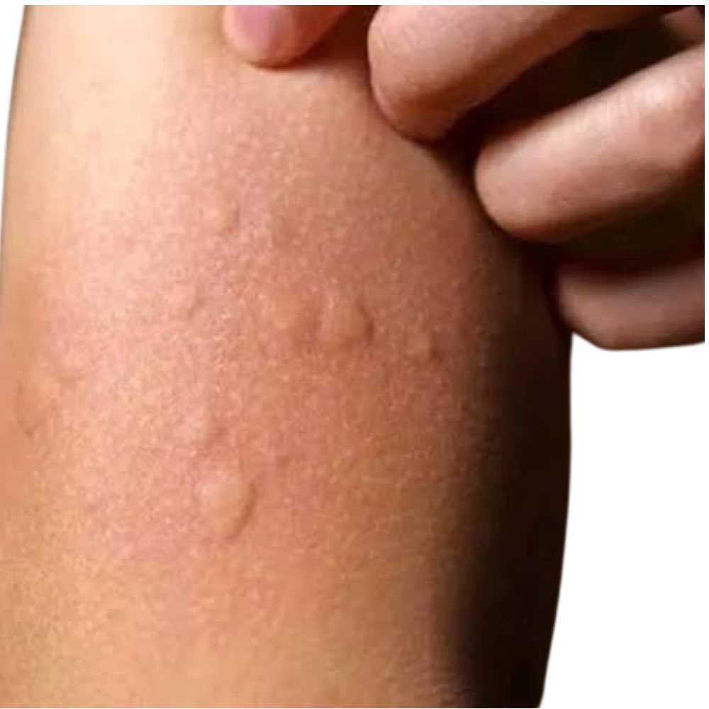 celebritypharm's tweet photo. CHOLINERGIC URTICARIA : CAUSES AND PREVENTION 

Have you ever  experienced serious itching when you exercise, when you’re stressed and when you eat spicy food? 

It could be Cholinergic urticaria. 

Cholinergic urticaria is also known as heat hives. 

They are raised red bumps that appear when your body heats up and you start to sweat. 

It's an immune reaction triggered by heat from activities like exercise, hot showers, or even anxiety.

Come with me 👇