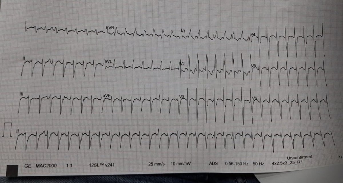 PurumittalDr's tweet photo. 14 yr male with palpitations, structurally normal heart.
What is your opinion @EkgHacks
@smithECGBlog
@ecgandrhythmRoe
@ecgrhythms
@ecgchallenge
@KostekMilan
#ecg
#epeep https://t.co/7c2Op5rP6Y