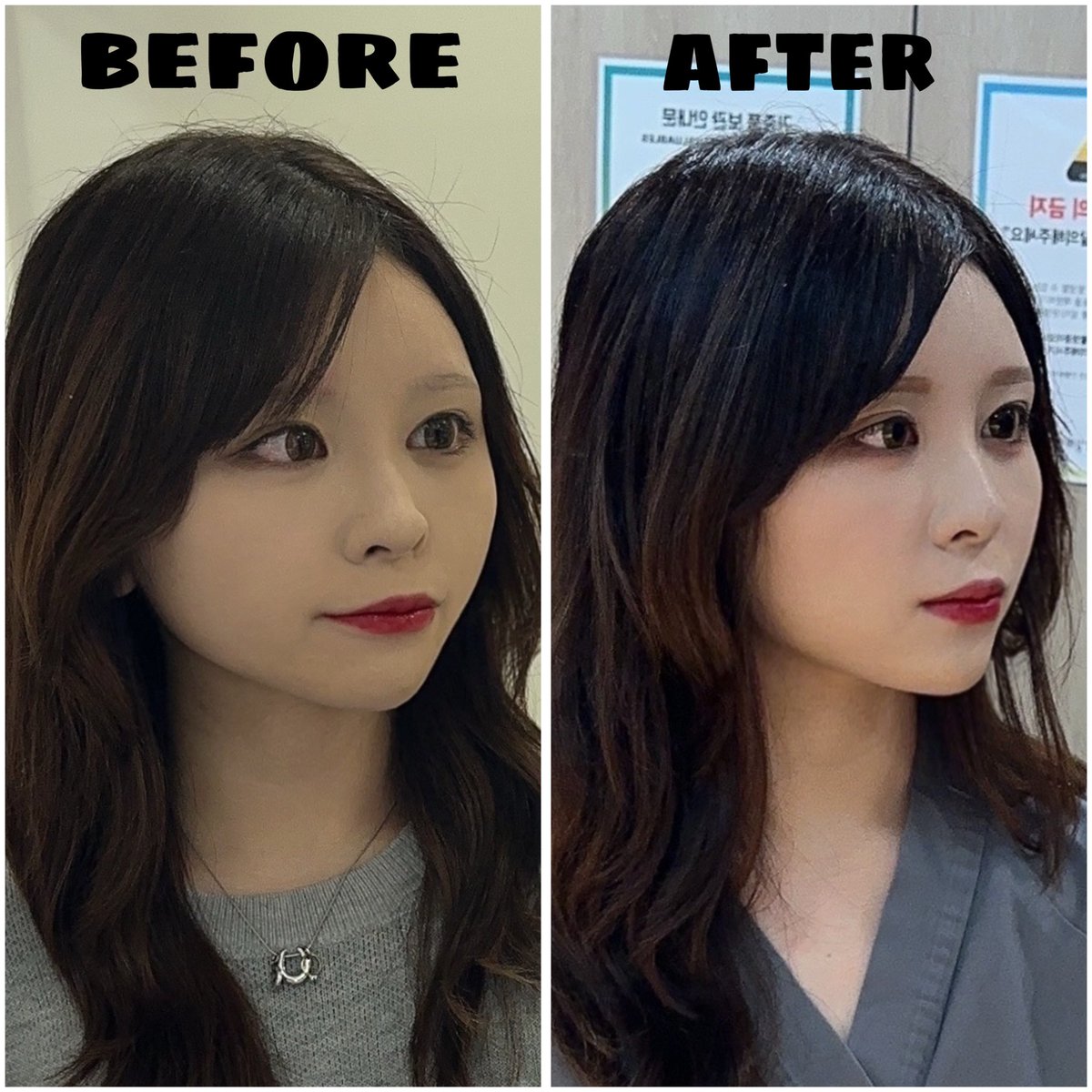 韓国の観光地弘大にある美容皮膚科に行ってきたよ♪♪
その名も『オブリージュ医院』✨️

カウンセリングの結果、
『オリジオ』を施術してもらったけど、
直後から効果を実感できて大満足🫶

みんなも行ってみてね🤍🏹  ̖́-

<a href="/ohvelyjoo_jp/">ohvelyjoo(オブリージュ医院) 弘大店</a>